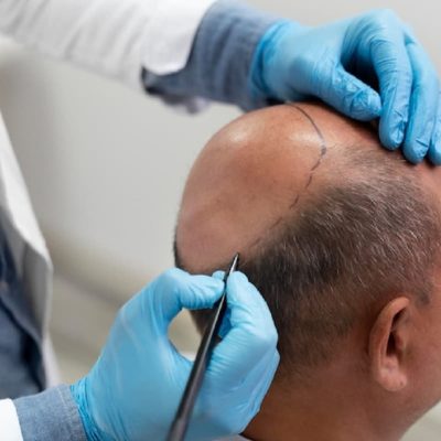 hair-transplant-turquie hair-transplant-turquie